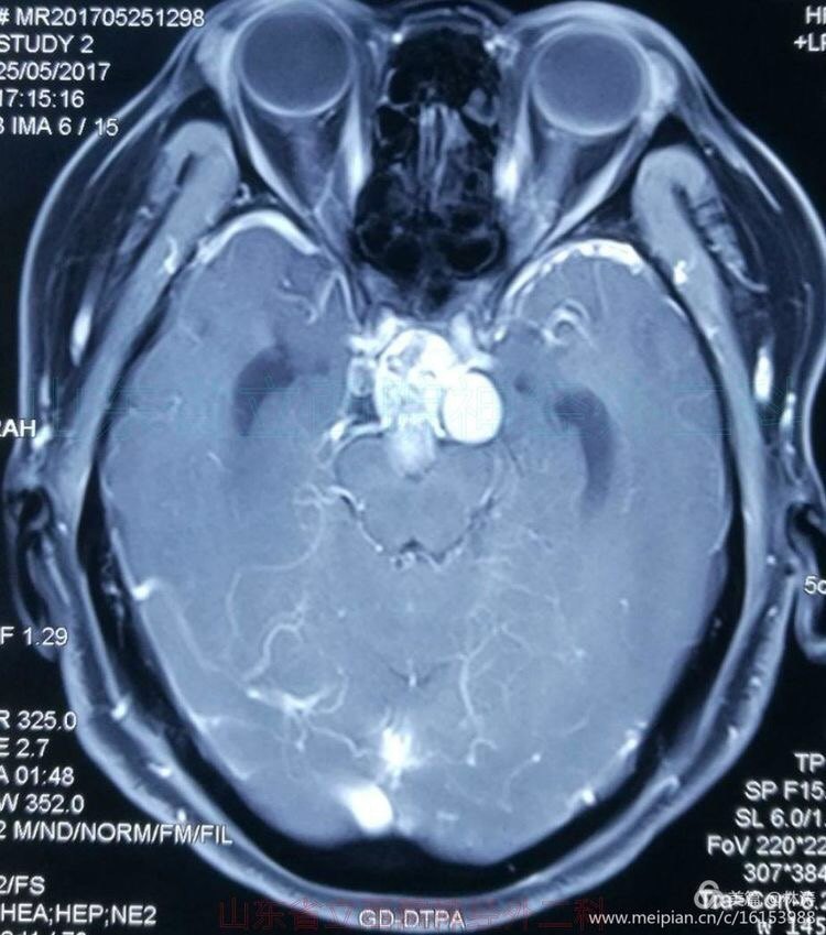 全切巨大钙化颅咽管瘤