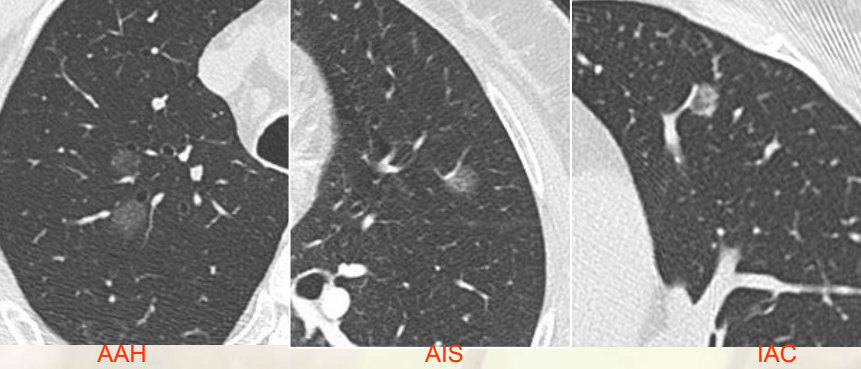 MSCT在肺腺癌亚型分型中的临床应用