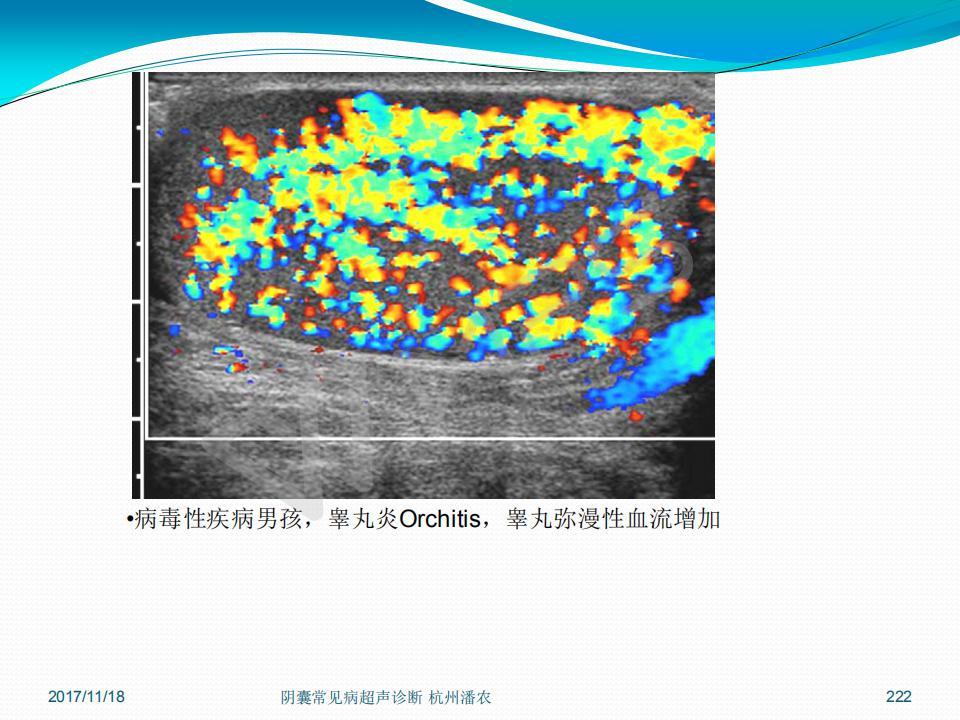 阴囊常见病超声诊断之二