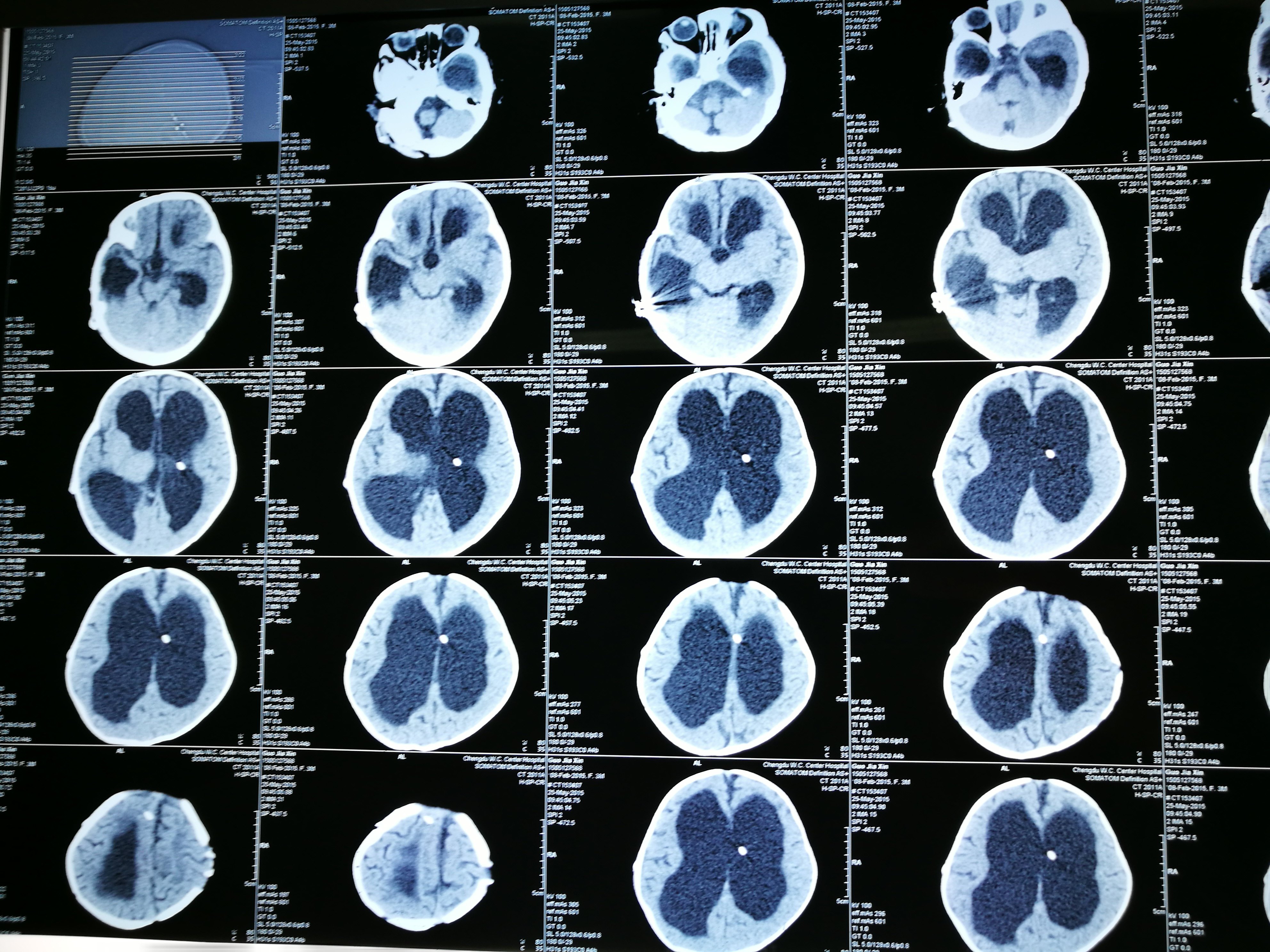 病例分享脑积水