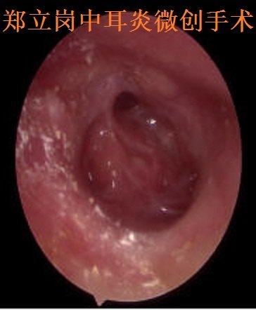 郑立岗中耳乳突炎耳内镜微创手术第584江西赣