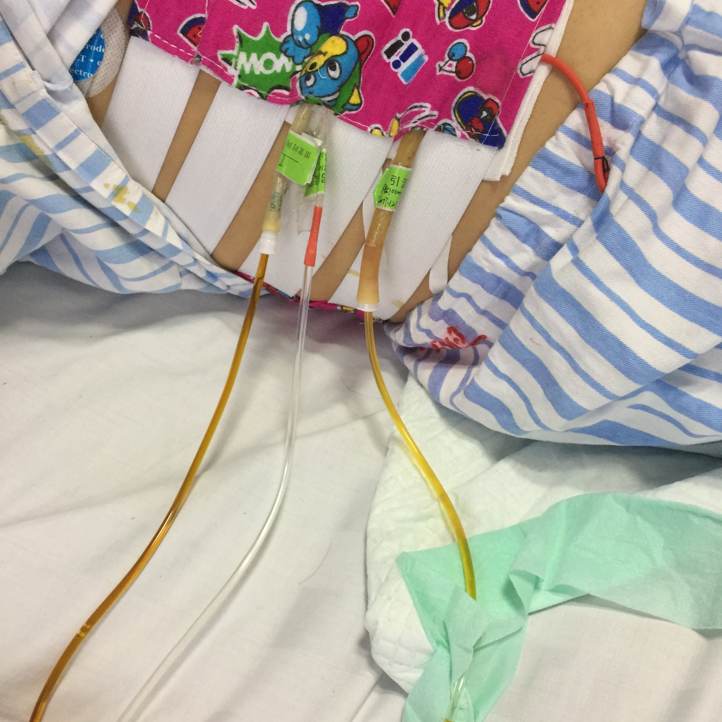 包裹性胰漏所幸动脉gda残端没在积液腔中