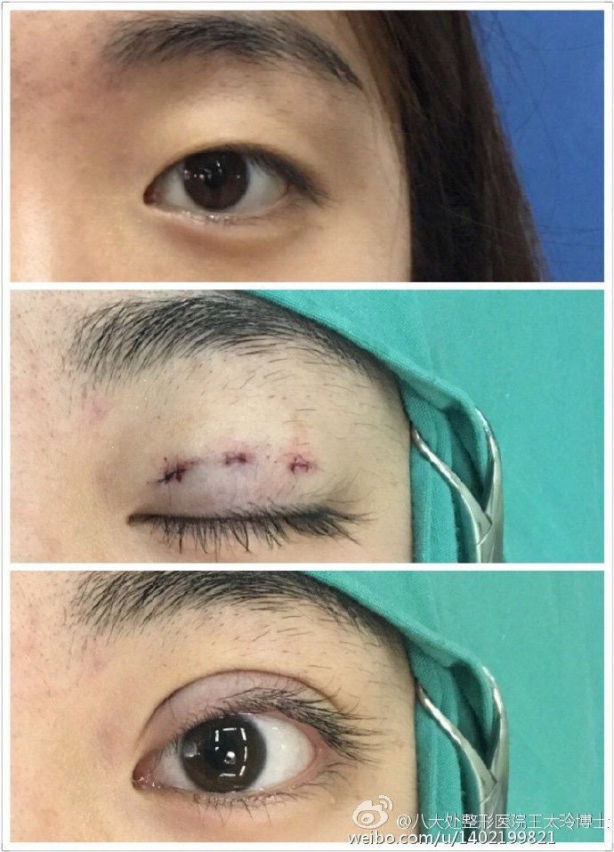 三点微创双眼皮案例2.jpg