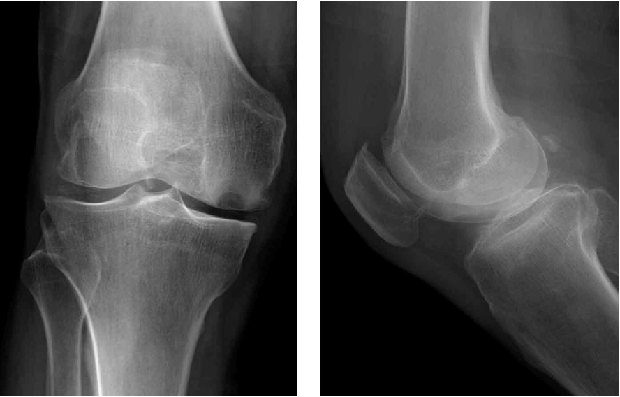 膝关节籽骨x线图片图片