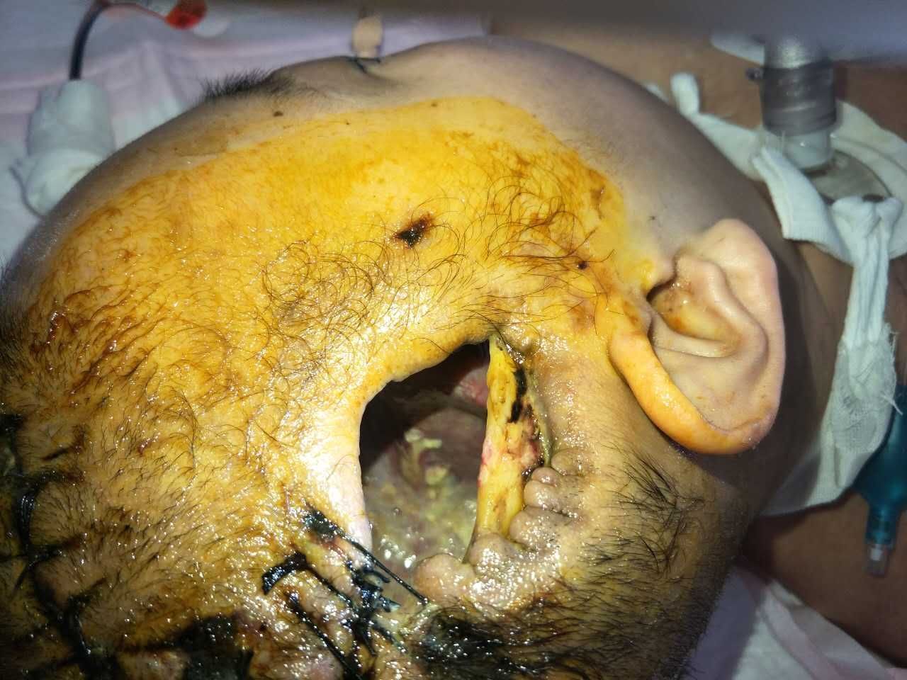 脑外伤术后还需积极治疗,否则还是脑死亡 - 好大夫在线