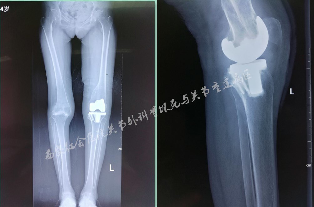 【病例分析】類風溼性關節炎20餘年膝關節內翻畸形