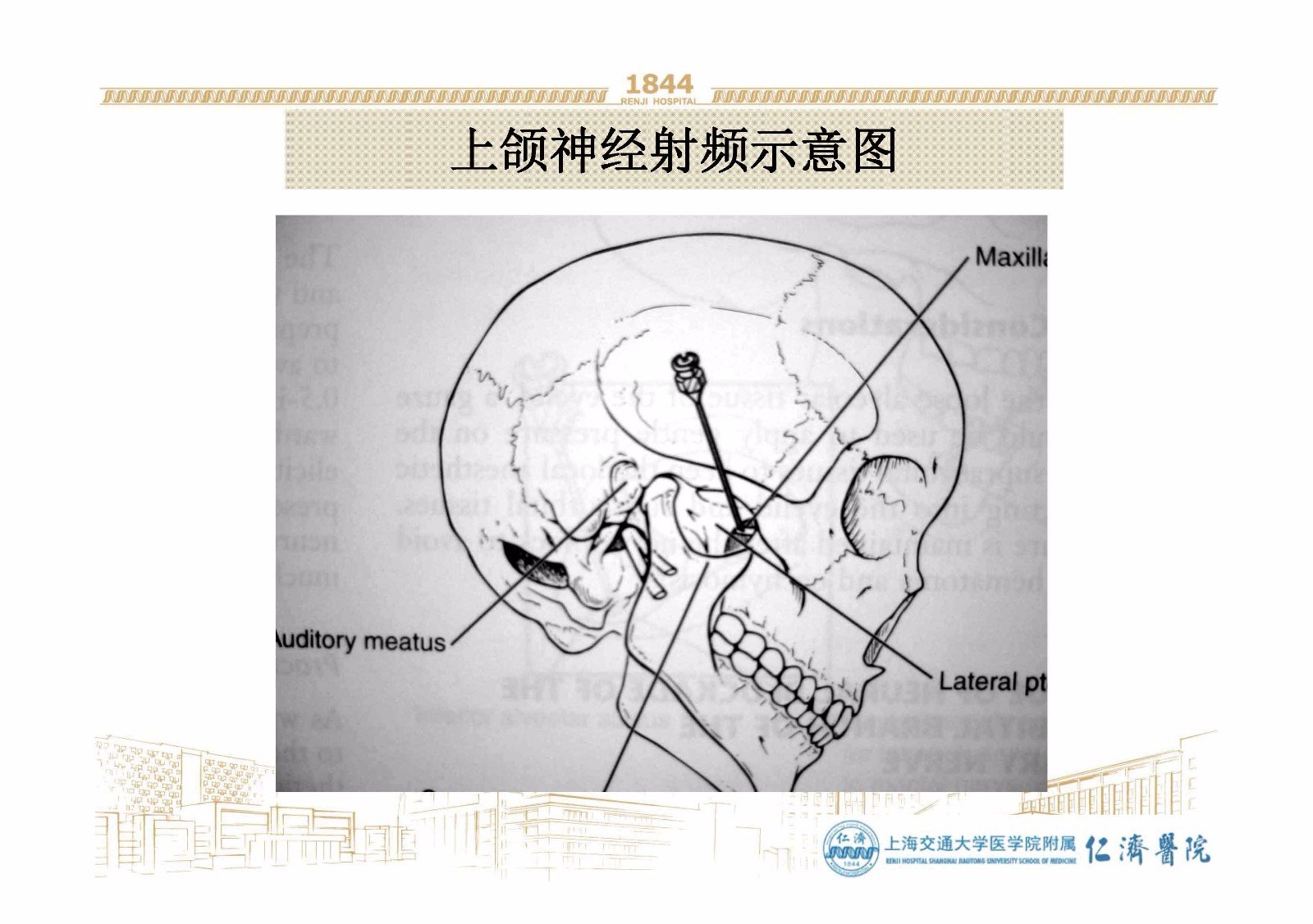 上颌神经及疼痛处理 - 好大夫在线