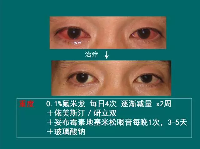 过敏性结膜炎的治疗 (ppt) - 好大夫在线