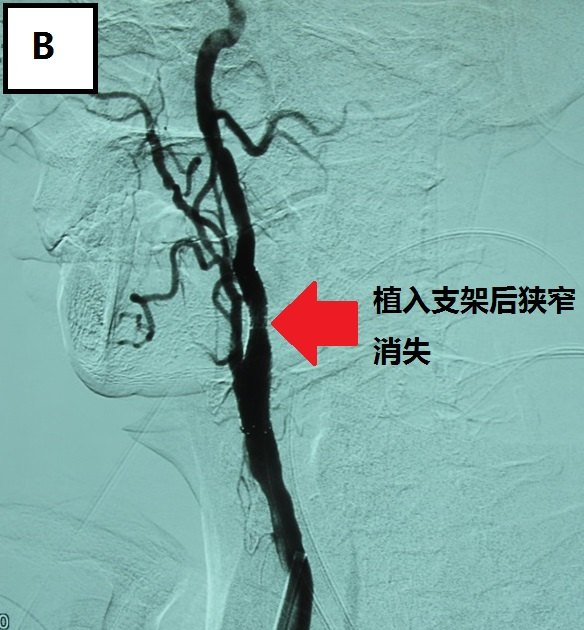 頸動脈支架成形術: a, 動脈造影可見左側頸內動脈起始部重度狹窄;b