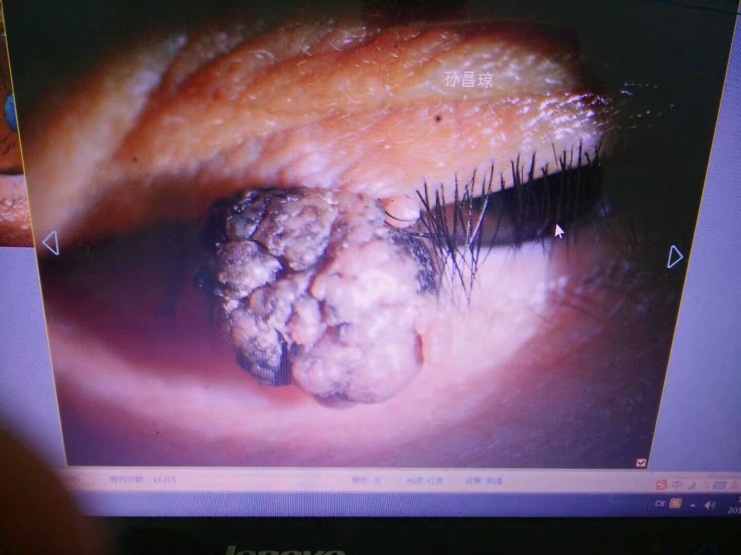 眼睑乳头状瘤图片