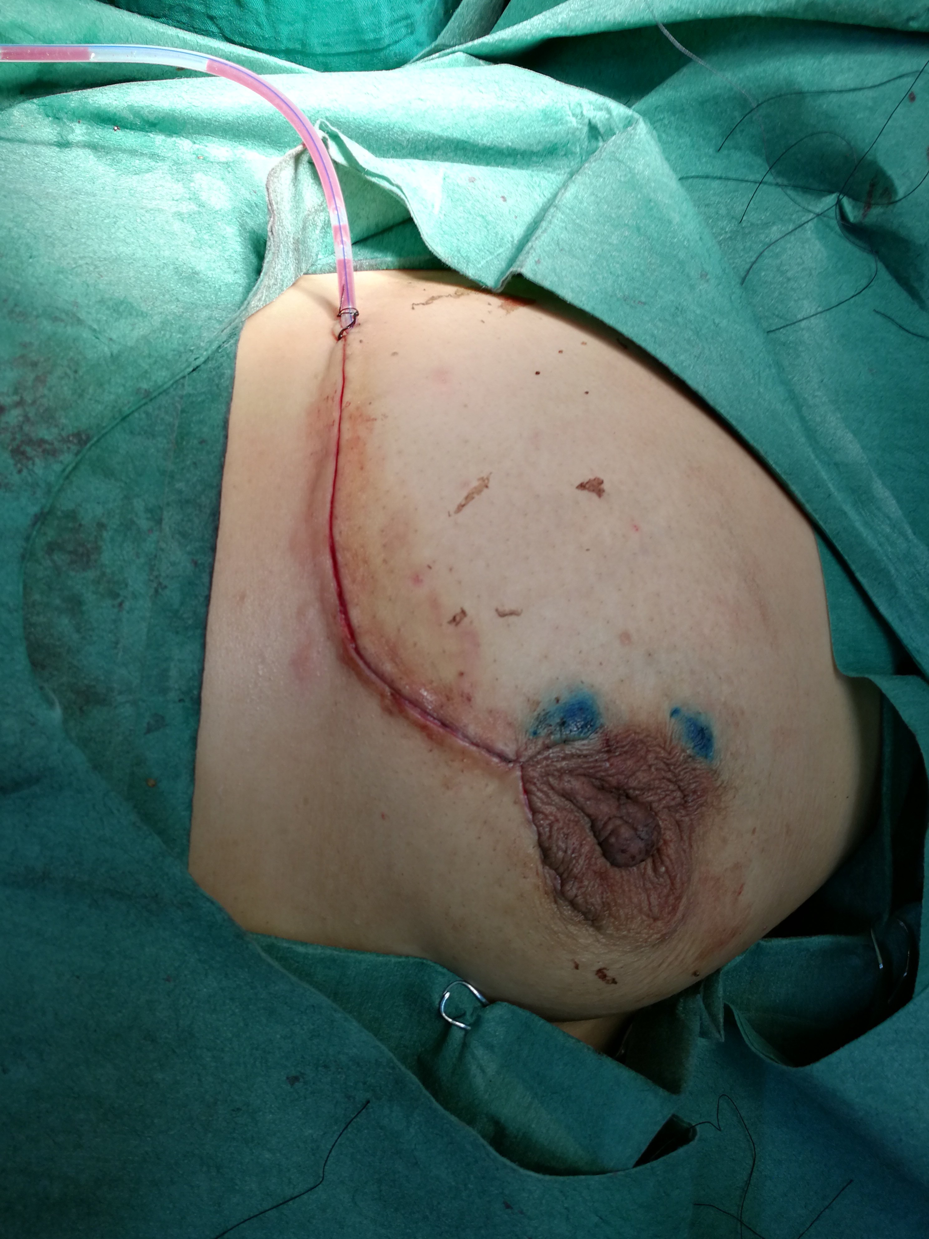 乳腺癌手术照片图图片