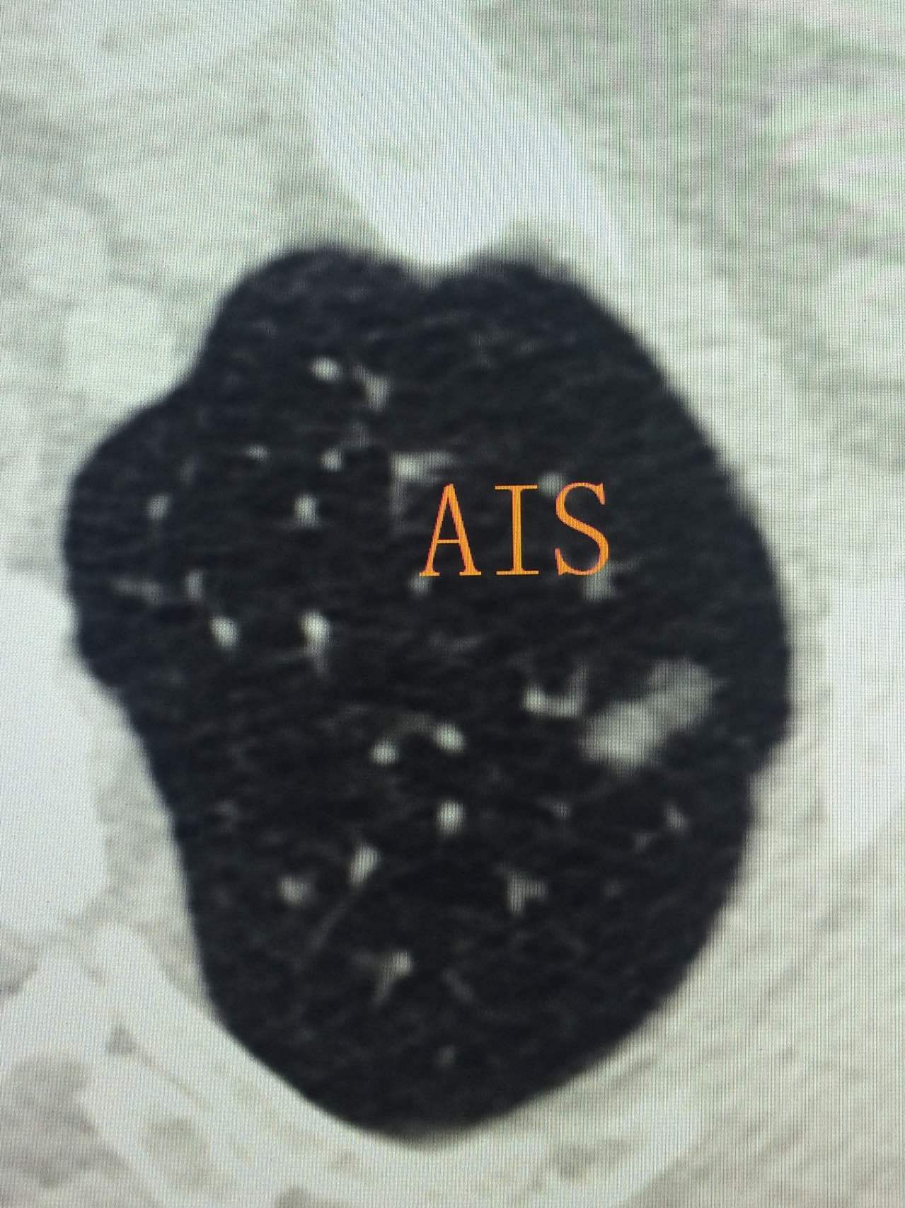 肺磨玻璃结节之2---AAH到AIS的演变