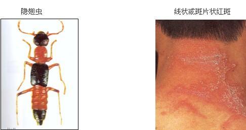 人体皮肤接触少量毒液后(如隐翅虫从皮肤上爬过),皮肤会出现点状,片状