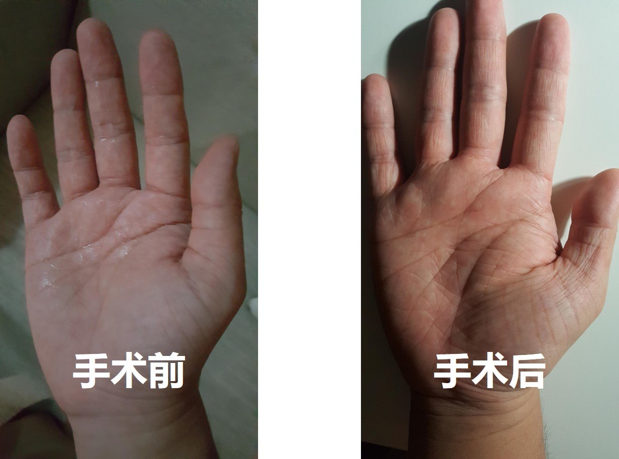 手汗症怎么治疗?
