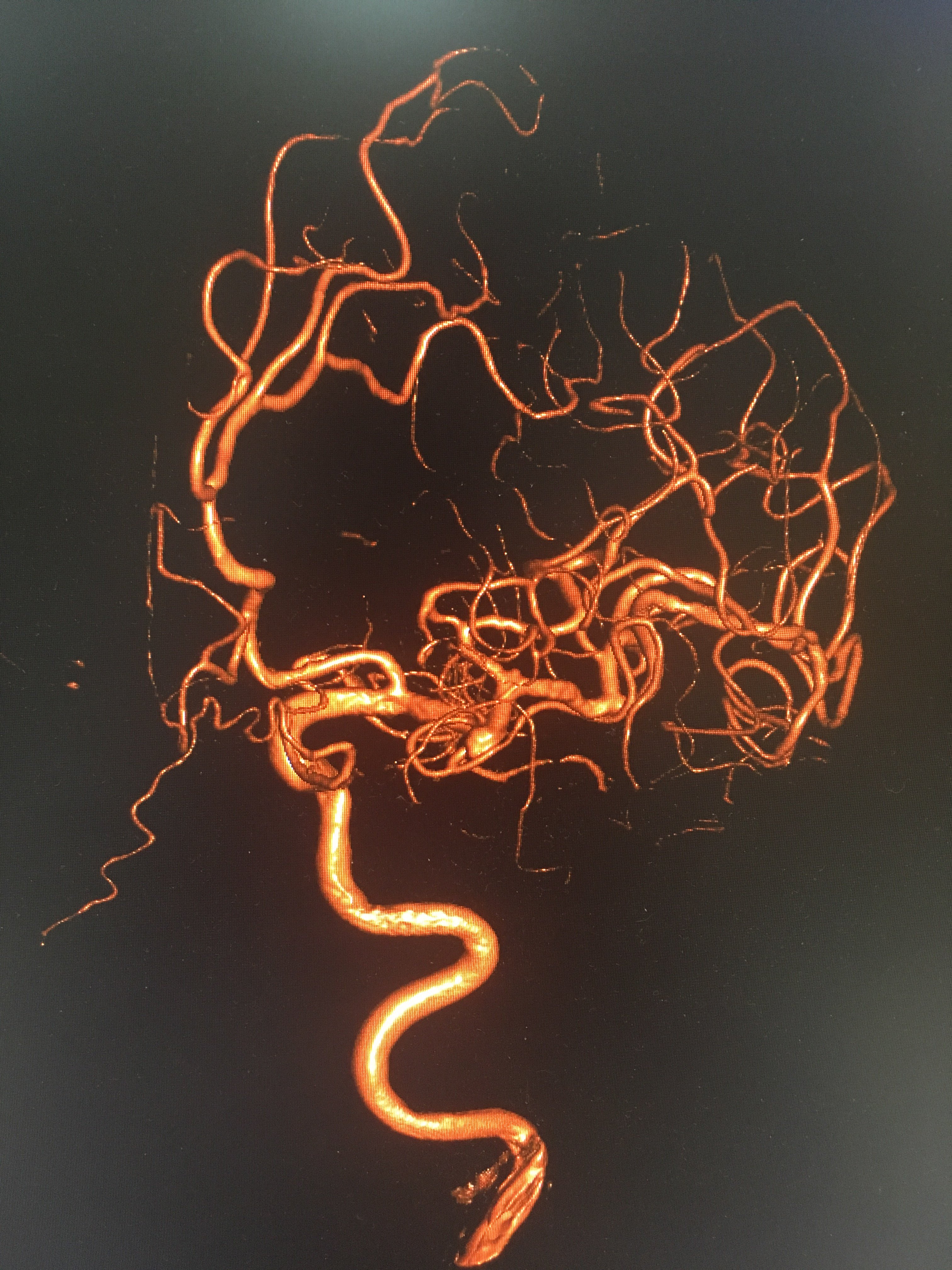 大脑中动脉动脉瘤m1段 - 好大夫在线