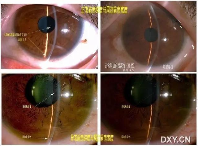 眼科医生多年总结:眼前节病例照片