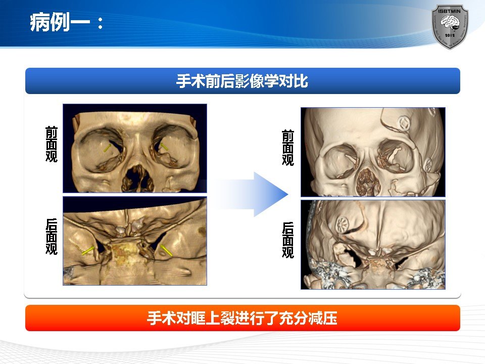 眶上裂綜合症的微創手術治療