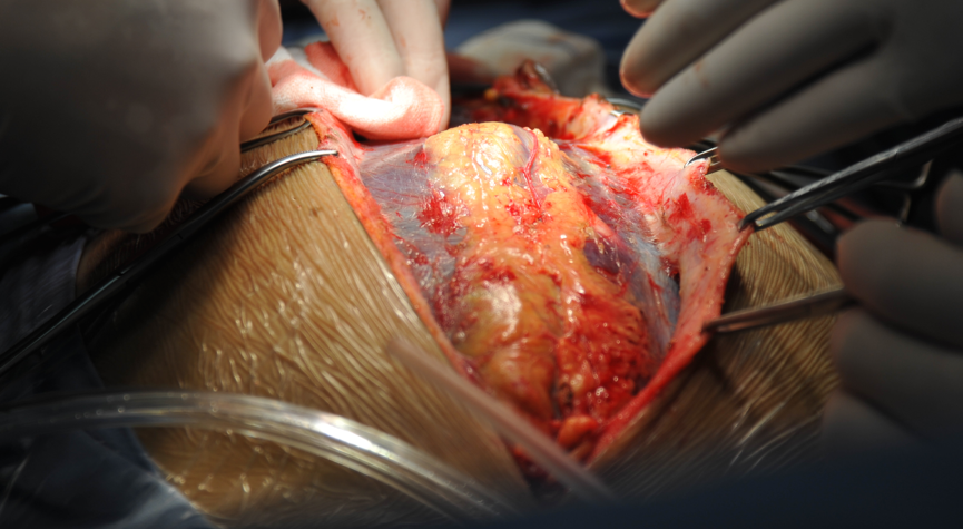 肝巨大血管瘤切除术1例