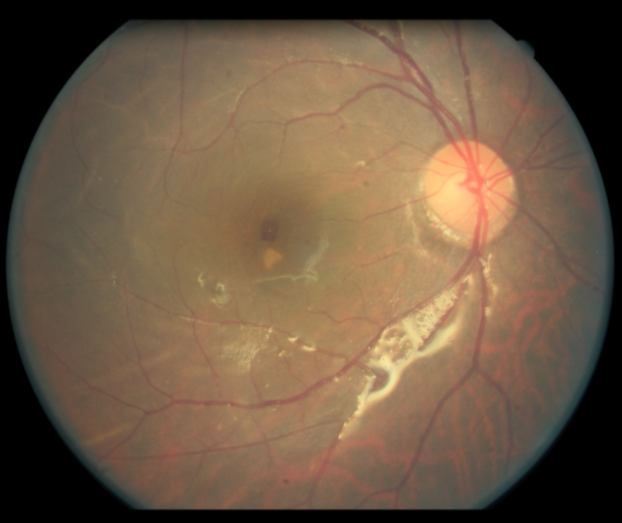 认识黄斑裂孔性视网膜脱离