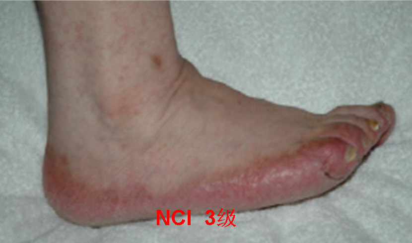 卡培他滨相关手足综合征防治全面解释,你想看的都在这里!