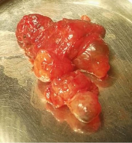 结节性甲状腺肿术后须服用优甲乐