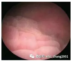 腺性膀胱炎 和普通膀胱炎不同 膀胱炎 膀胱炎