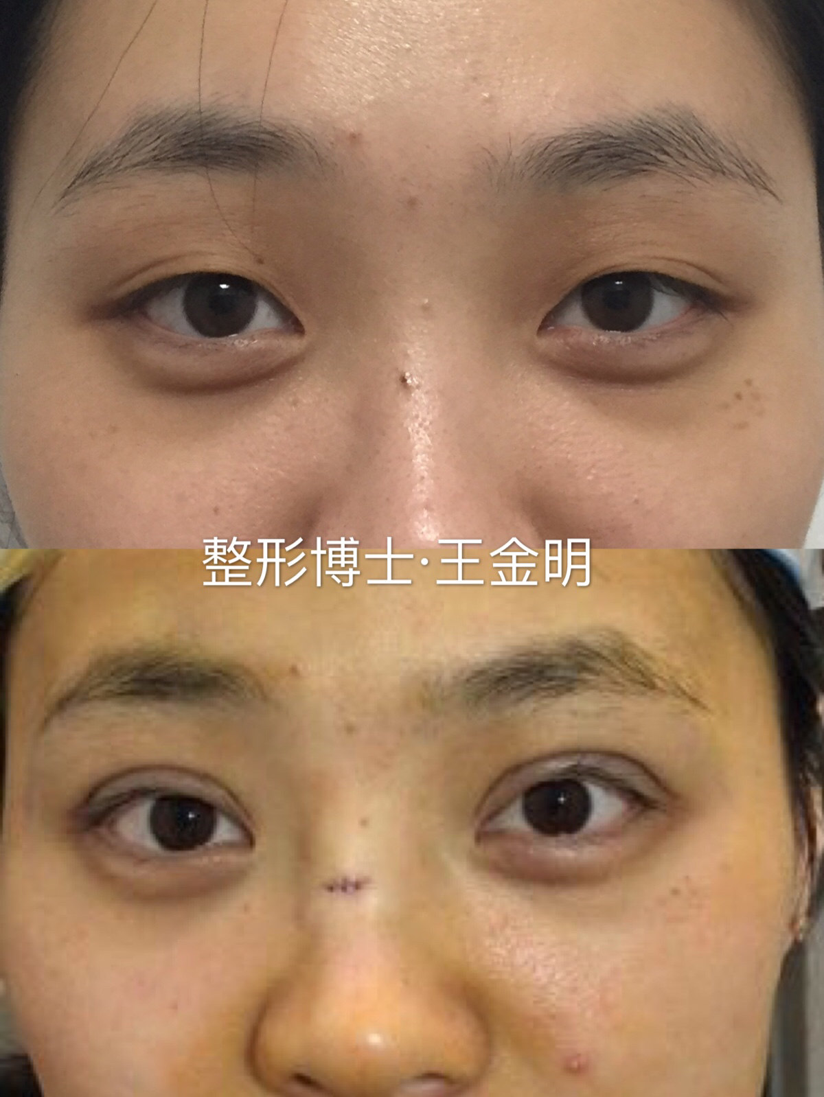 这是目前比较流行的双眼皮类型 - 好大夫在线