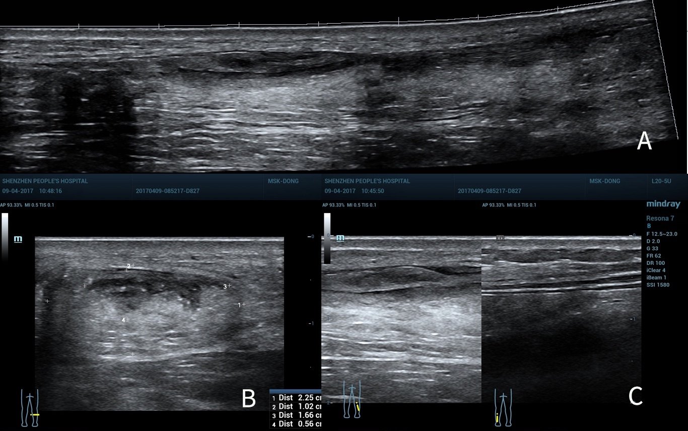 景长轴成像,b短轴成像,c双侧对比扫查,显示跟腱肿胀,浅方肌腱局部撕裂