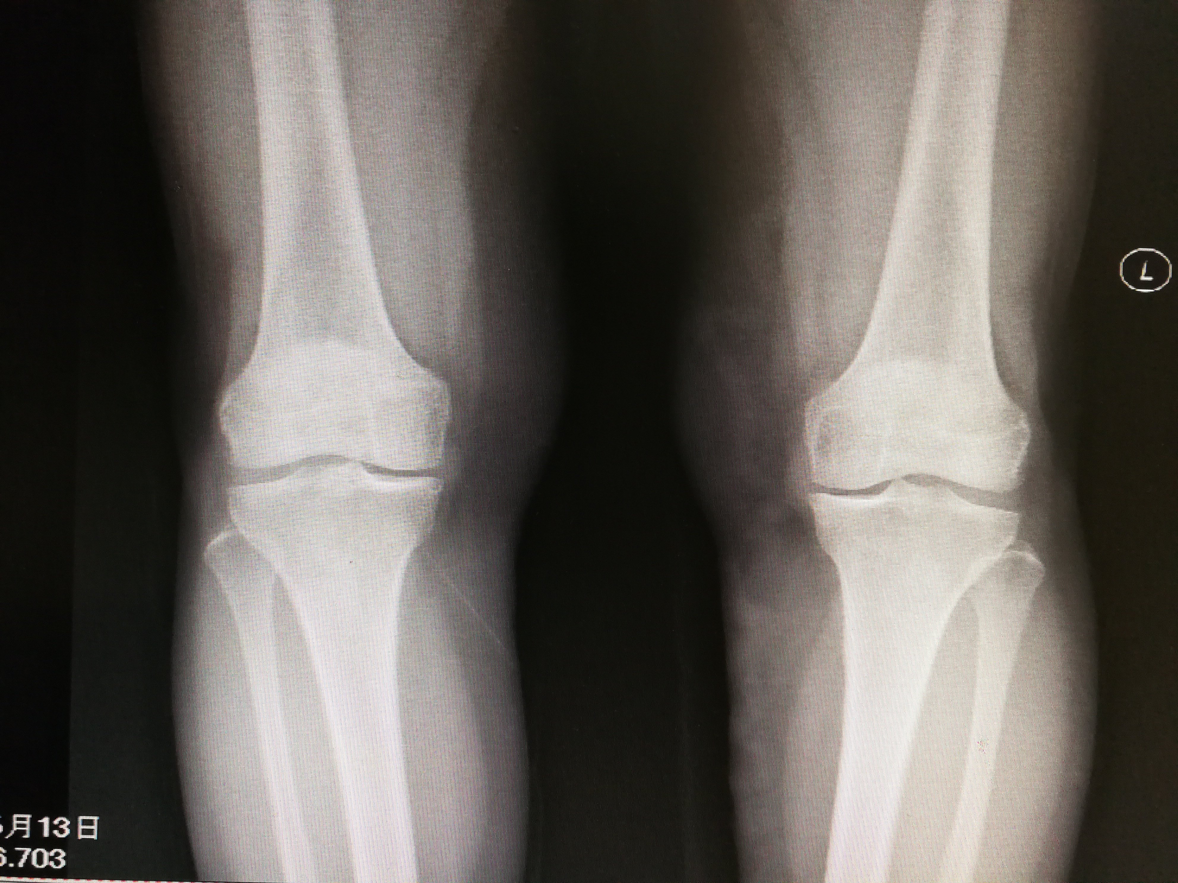 部分膝关节置换:双侧同期单髁置换术治疗双膝骨关节炎 