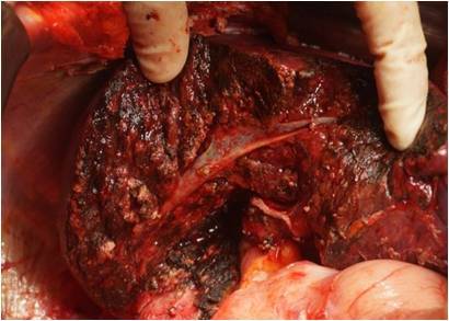 结直肠癌肝转移的治愈之路—mdt(多学科协作)携手同行 - 好大夫在线