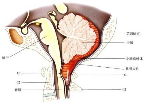 下疝畸形是由于胚胎发育异常使小脑扁桃体下部下降至枕骨大孔以下