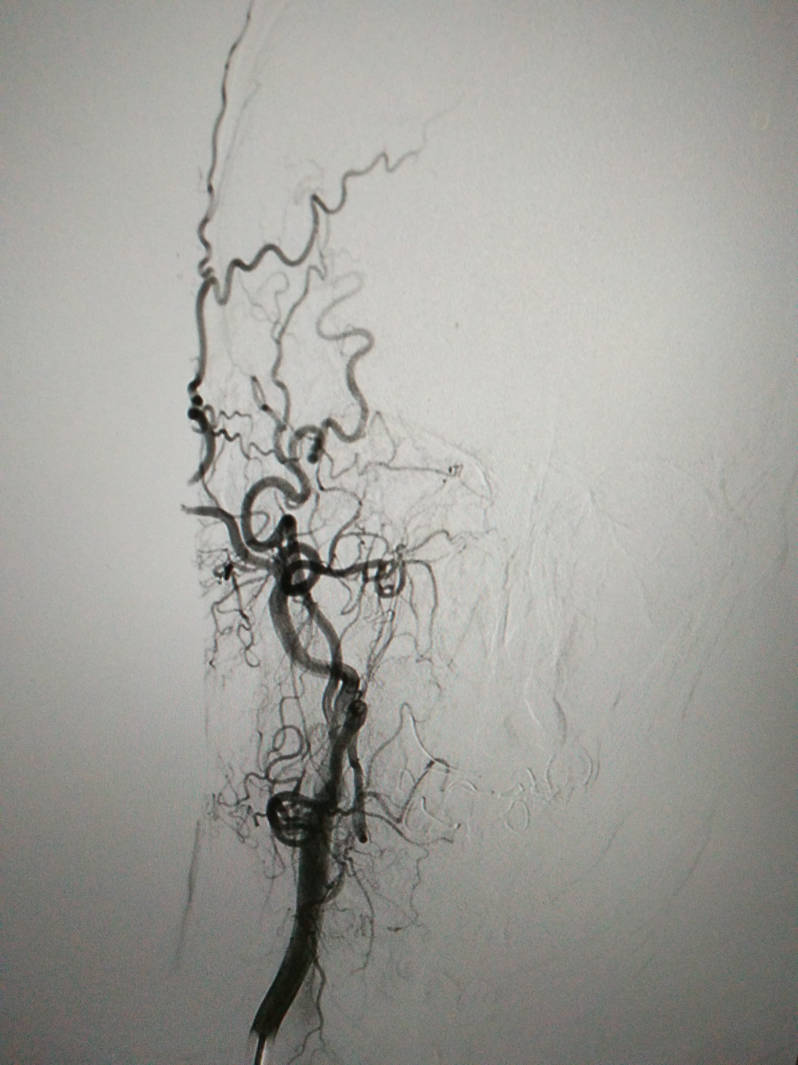 右侧颈内动脉全程闭塞(正位)