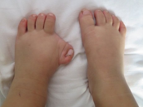 胡一刀告诉你:儿童脚趾畸形怎么办