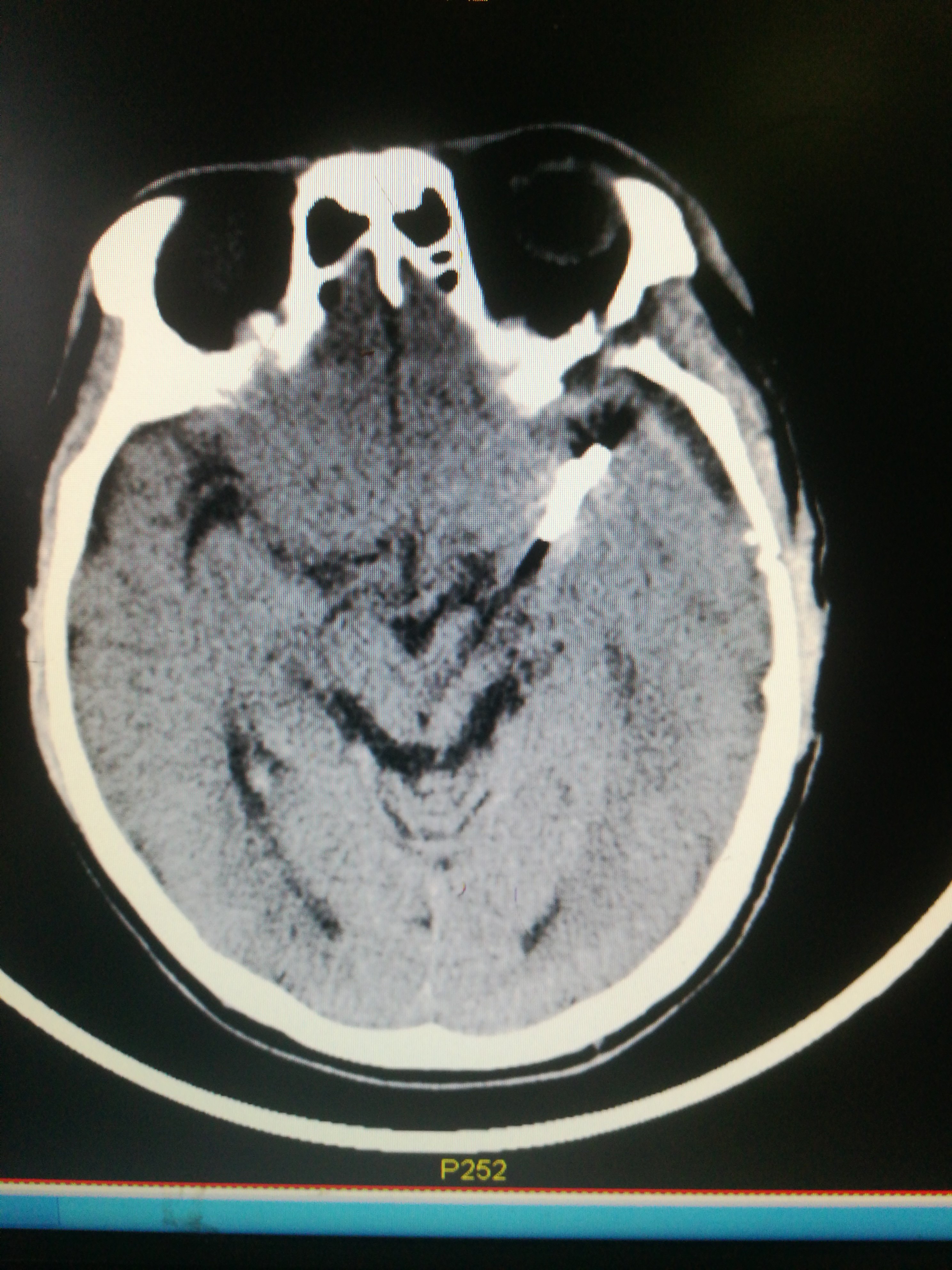 颅内动脉瘤ct表现图片