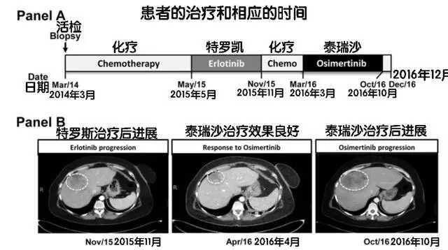 EGFR基因扩增:肺癌泰瑞沙(AZD9291)耐药新机