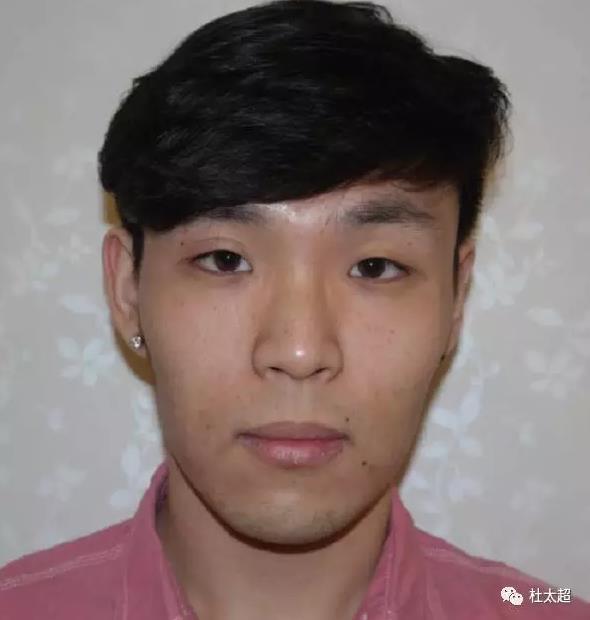 杜主任的面诊发现:小文的脸型是长脸,三庭比例不是特别协调,中庭偏短