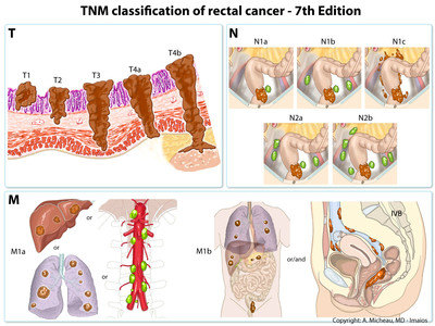 结肠癌的分型图片