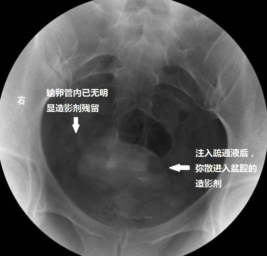 输卵管介入导丝疏通术--输卵管堵塞的一种治疗方法 - 好大夫在线