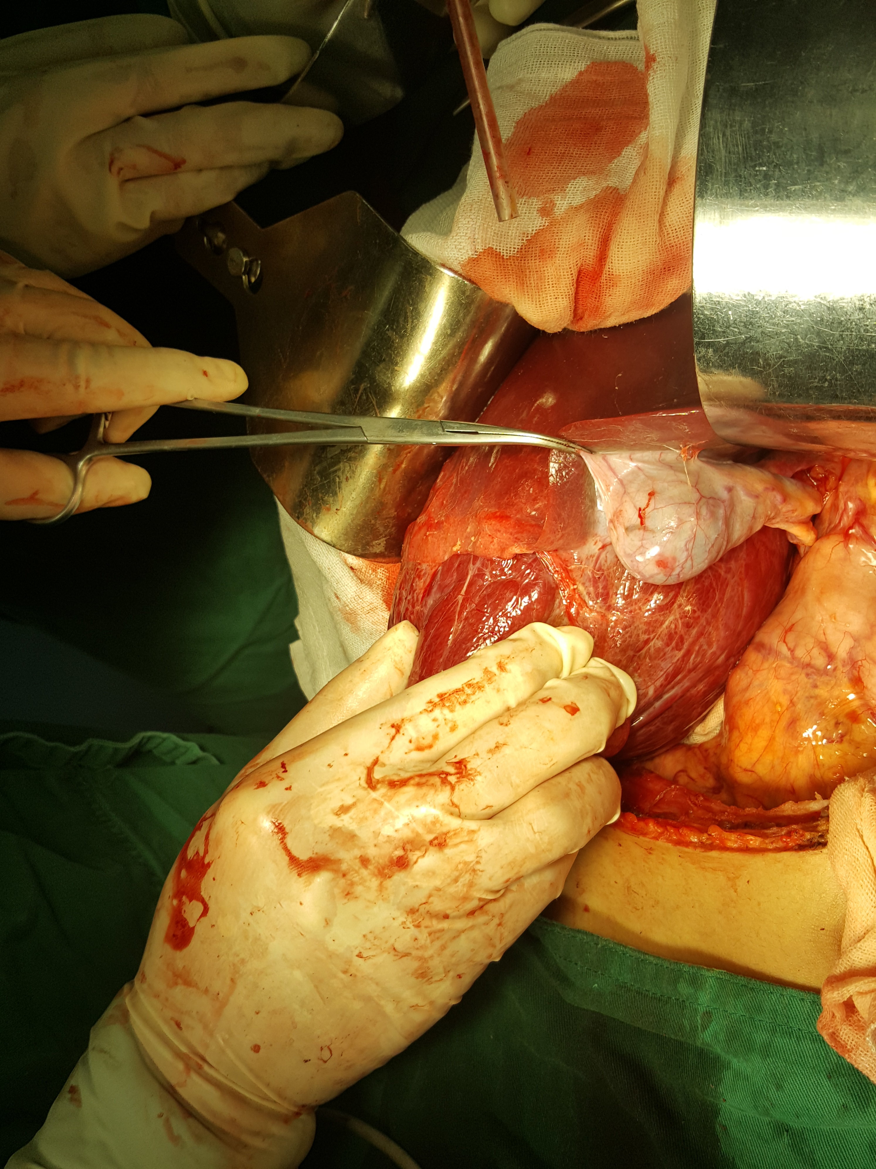 外一科手术切除肝右叶巨大fnh1例 - 好大夫在线