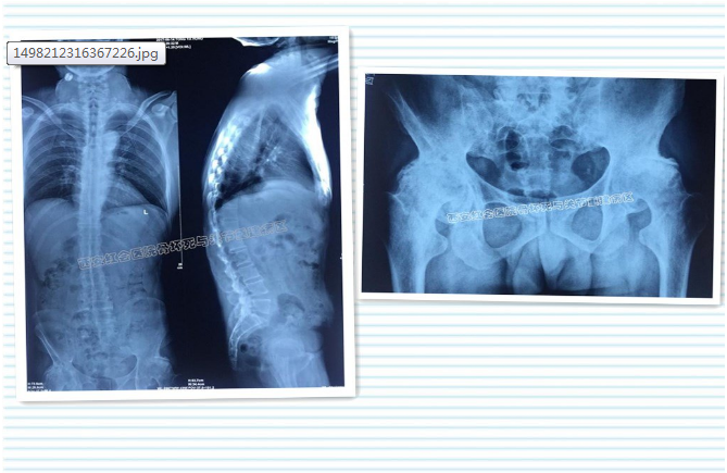 x線檢查結果顯示:骶髂關節間隙消失,雙側髖關節間隙狹窄,而且髖關節