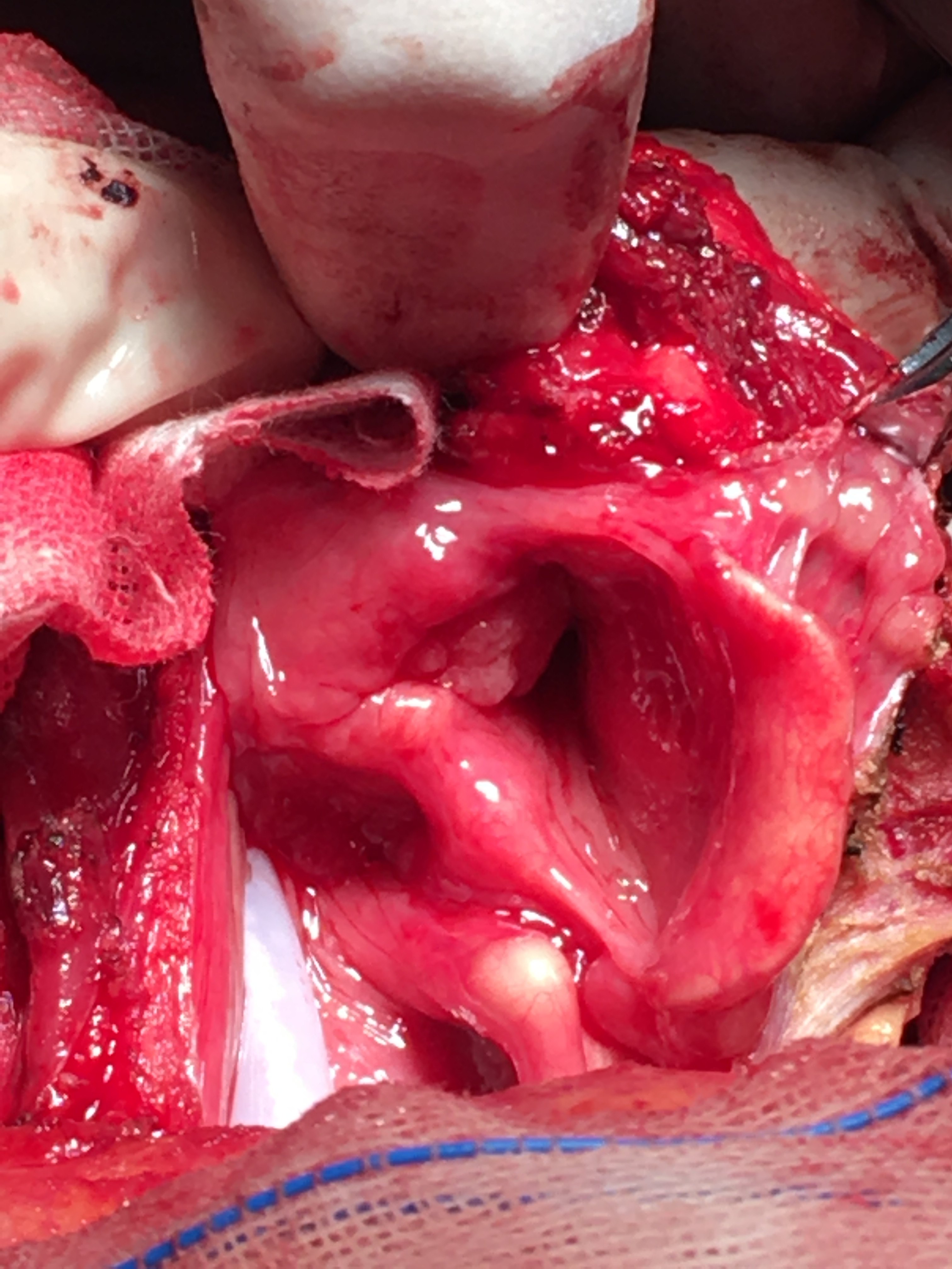 喉癌手术 - 好大夫在线