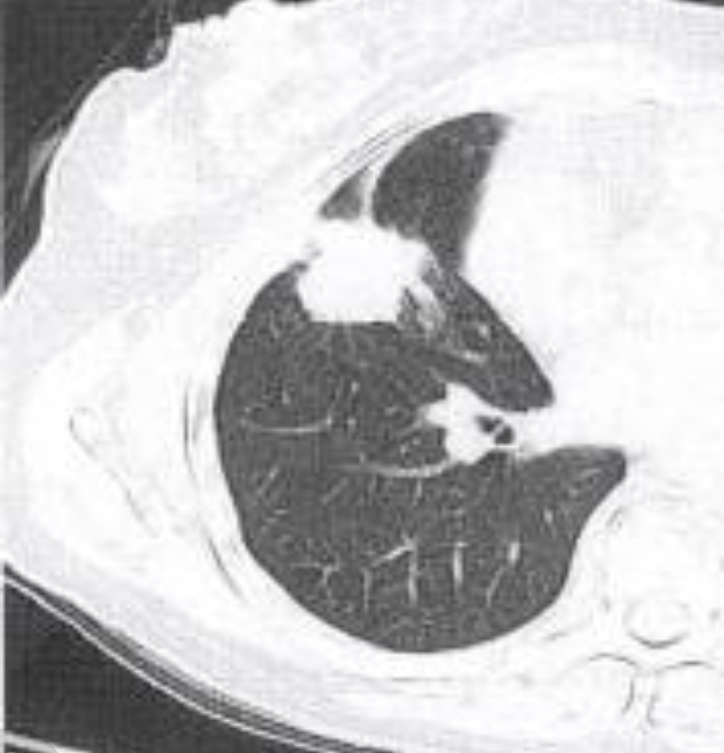 肺部结节边缘凹凸不平的分叶状轮廓,是该征的主要x线表现,对于较大的