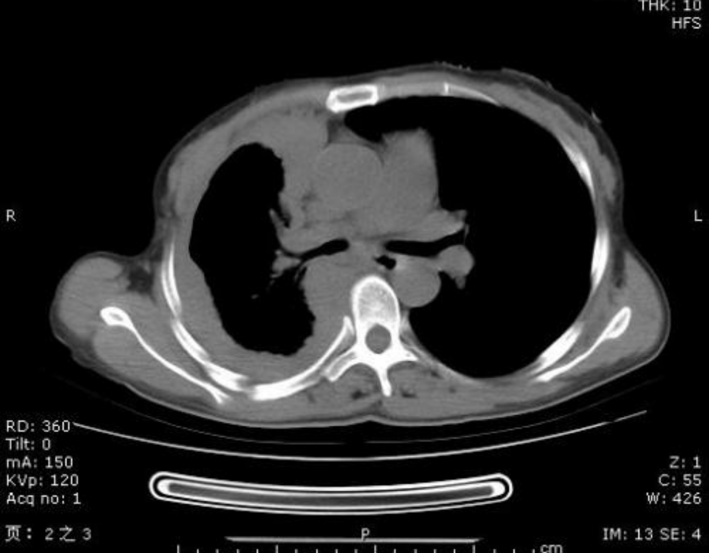 典型胸膜增厚ct图片图片