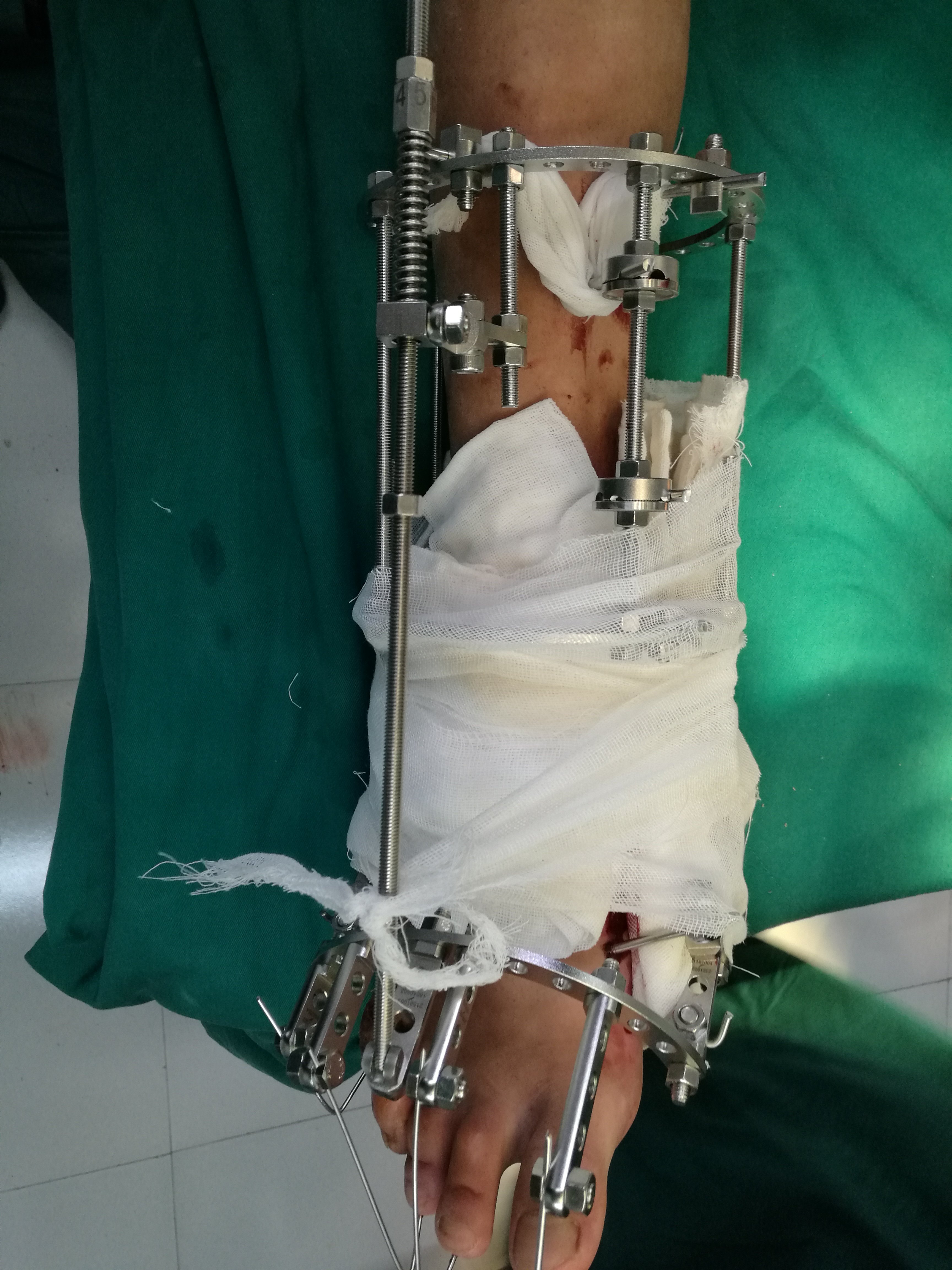 马蹄内翻足畸形,可以通过跟腱延长,三关节截骨,融合,胫前肌腱重建足