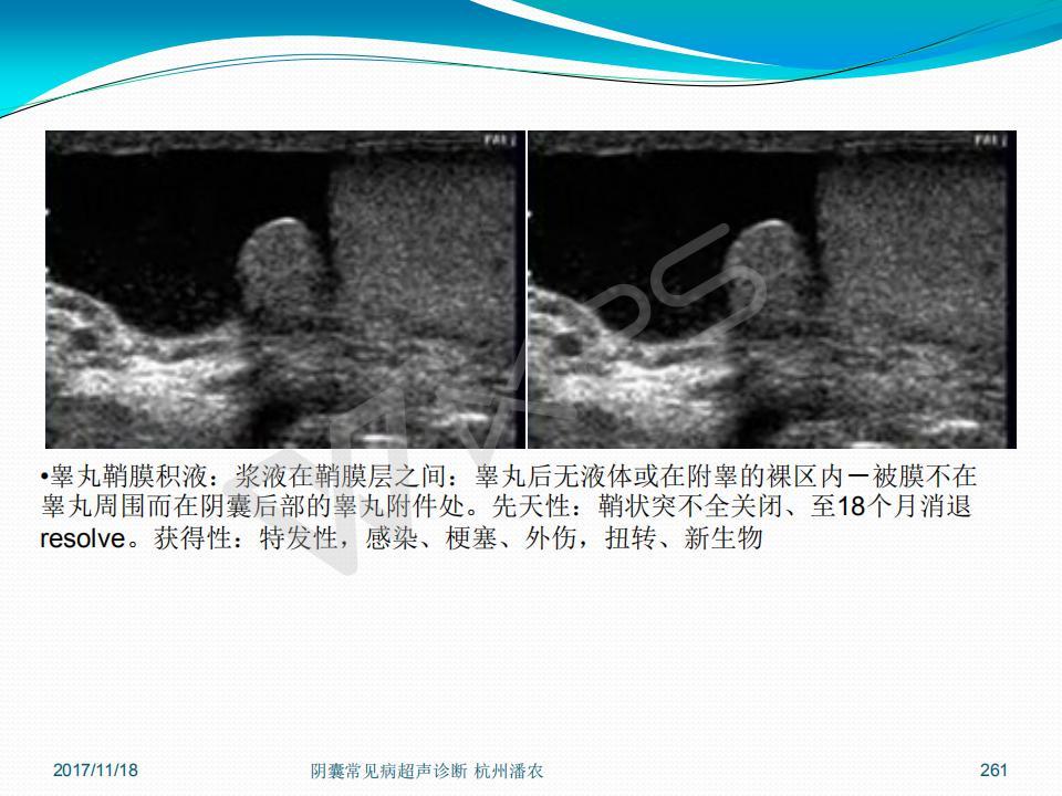 阴囊常见病超声诊断之三