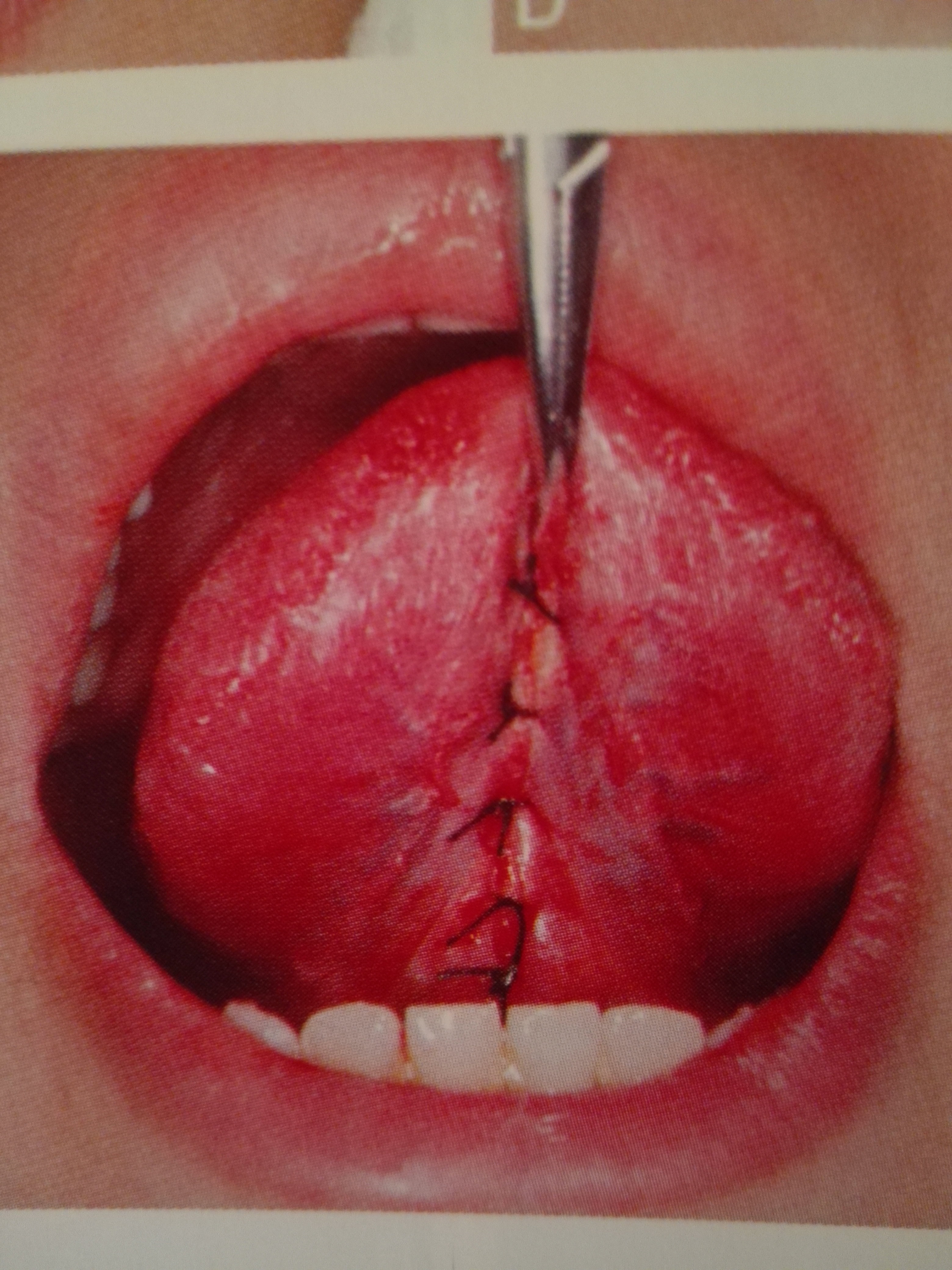 成人舌系带手术图片