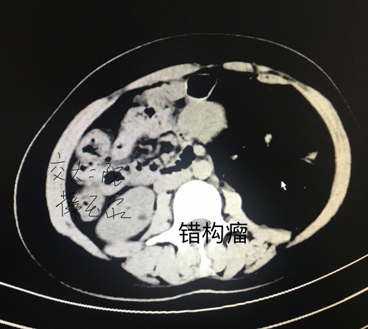 肾错构瘤你需要知道的十句话