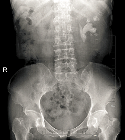 肾结石平片图片