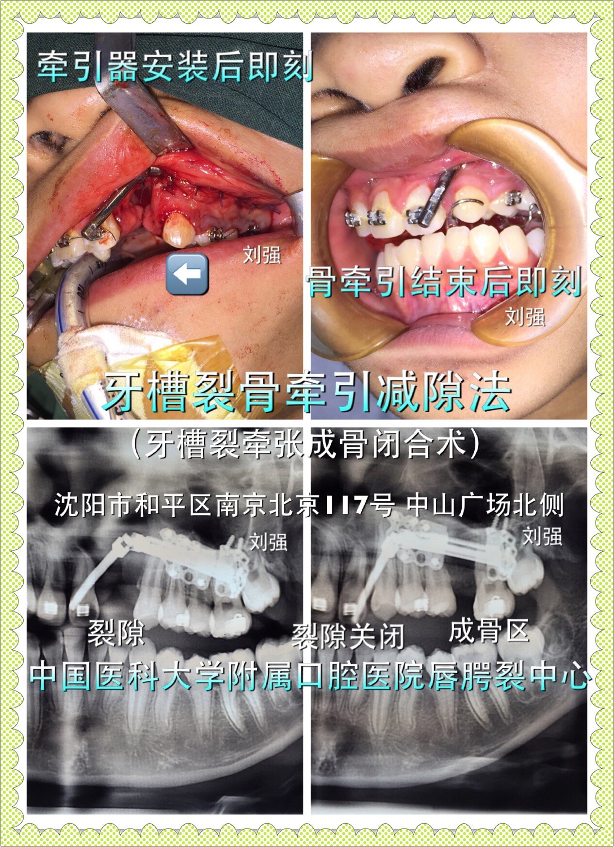 牙槽裂术前后图片图片