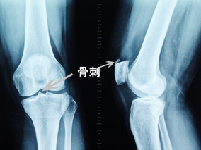 早期,骨刺主要体现在髁间嵴,表现为髁间嵴变尖,骨刺继续发展的话,膝